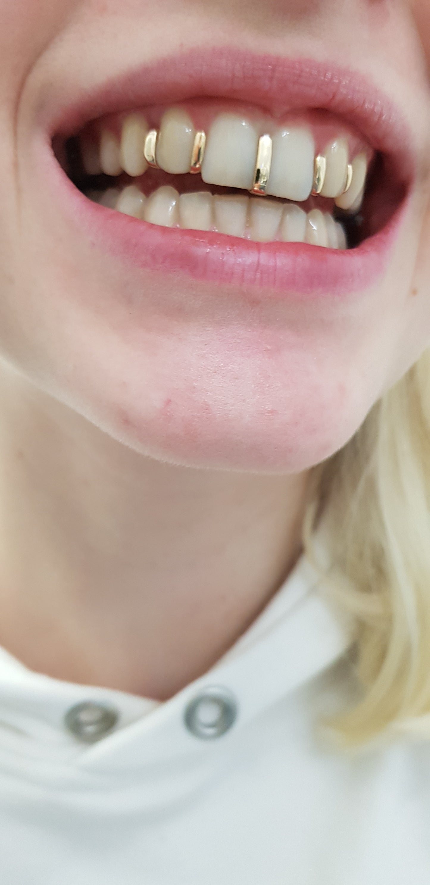 "Split Grillz – Clean Line Look"