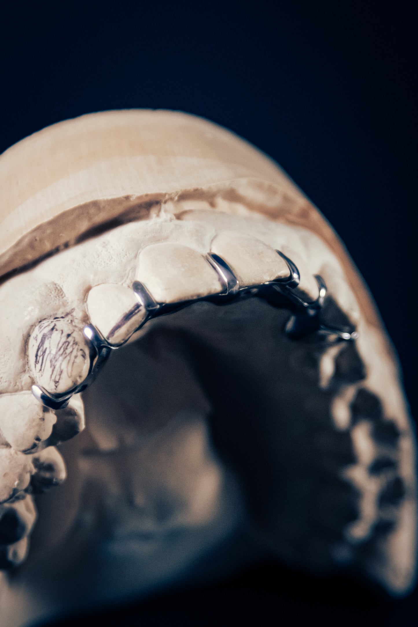 "Split Grillz – Clean Line Look"